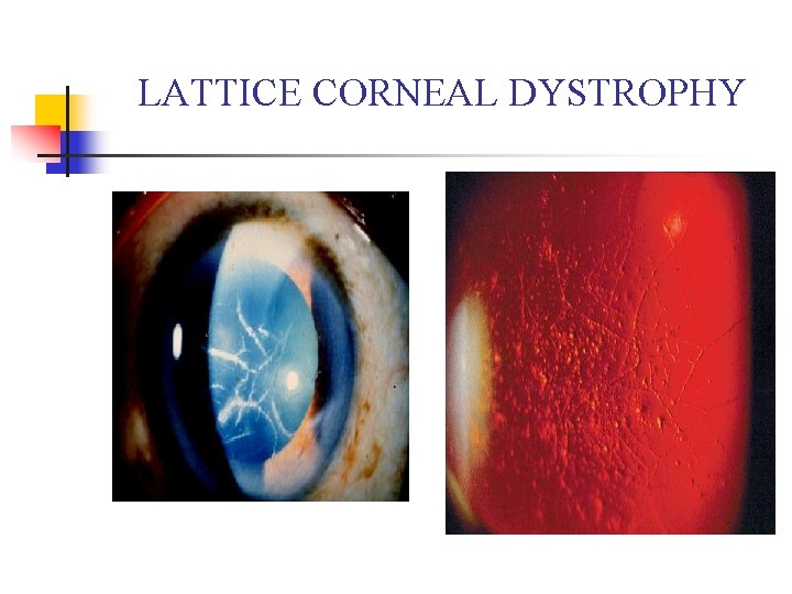 LATTICE CORNEAL DYSTROPHY 