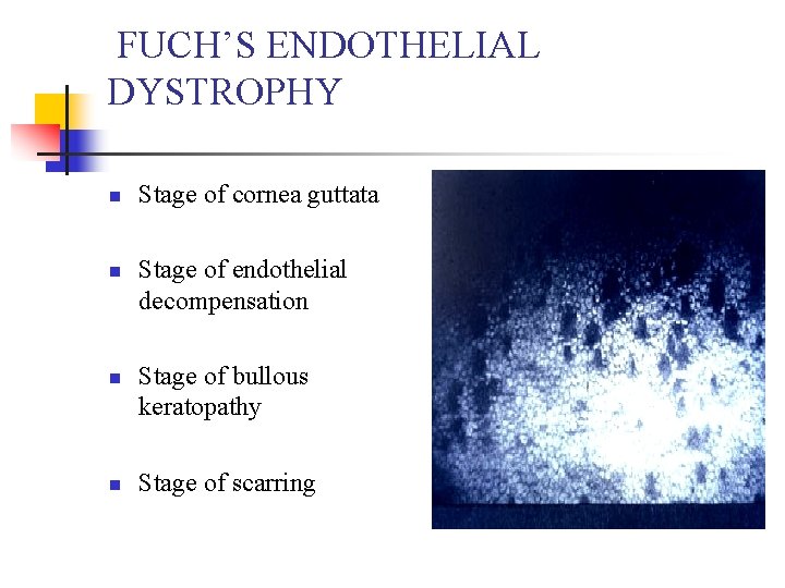 FUCH’S ENDOTHELIAL DYSTROPHY n n Stage of cornea guttata Stage of endothelial decompensation Stage