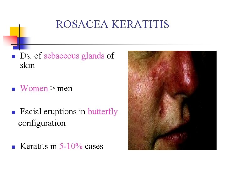 ROSACEA KERATITIS n n Ds. of sebaceous glands of skin Women > men Facial