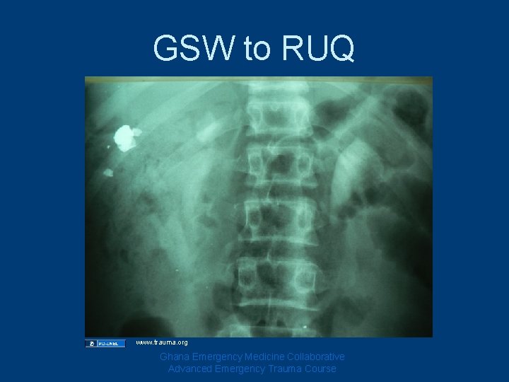 GSW to RUQ www. trauma. org Ghana Emergency Medicine Collaborative Advanced Emergency Trauma Course
