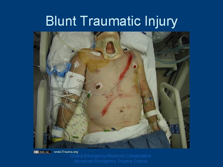 Blunt Traumatic Injury www. Trauma. org Ghana Emergency Medicine Collaborative Advanced Emergency Trauma Course