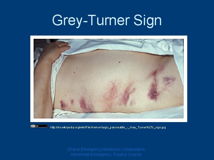 Grey-Turner Sign http: //en. wikipedia. org/wiki/File: Hemorrhagic_pancreatitis_-_Grey_Turner%27 s_sign. jpg Ghana Emergency Medicine Collaborative Advanced