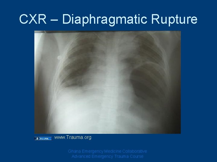 CXR – Diaphragmatic Rupture www. Trauma. org Ghana Emergency Medicine Collaborative Advanced Emergency Trauma