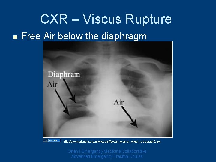 CXR – Viscus Rupture n Free Air below the diaphragm http: //ejournal. afpm. org.