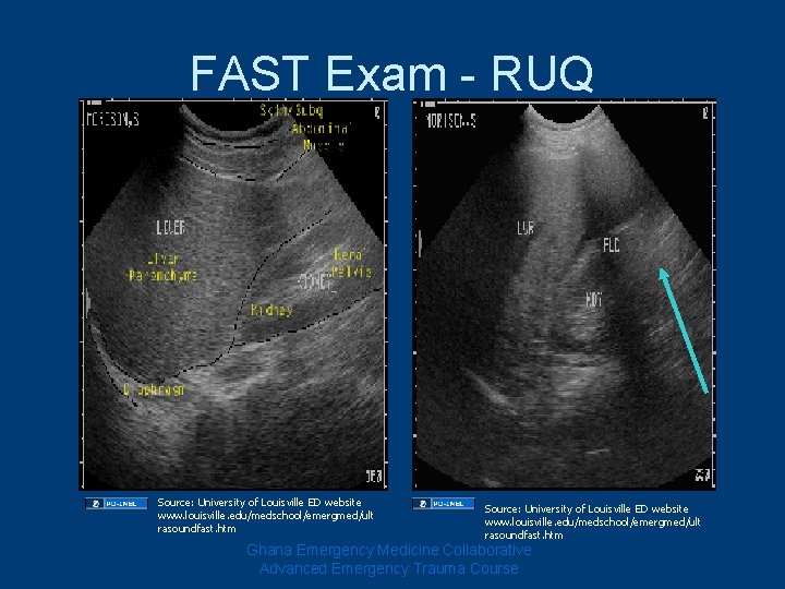 FAST Exam - RUQ Source: University of Louisville ED website www. louisville. edu/medschool/emergmed/ult rasoundfast.