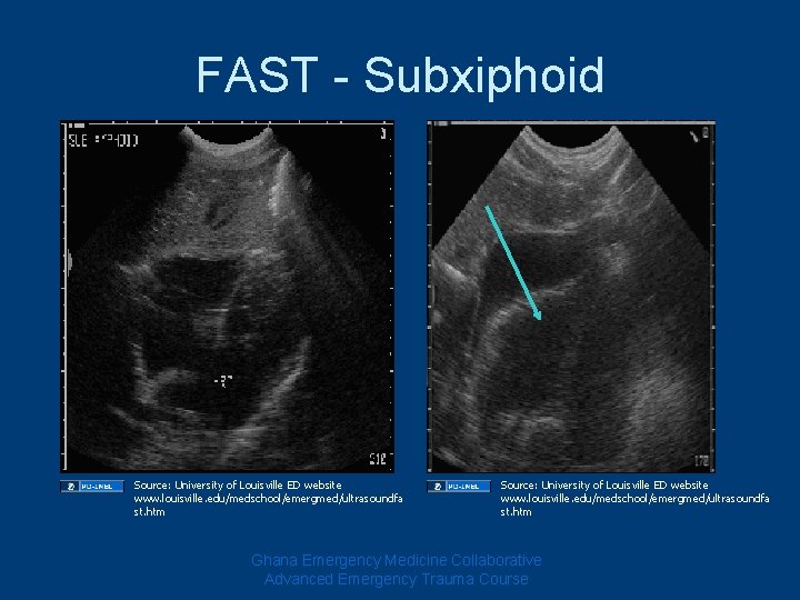 FAST - Subxiphoid Source: University of Louisville ED website www. louisville. edu/medschool/emergmed/ultrasoundfa st. htm