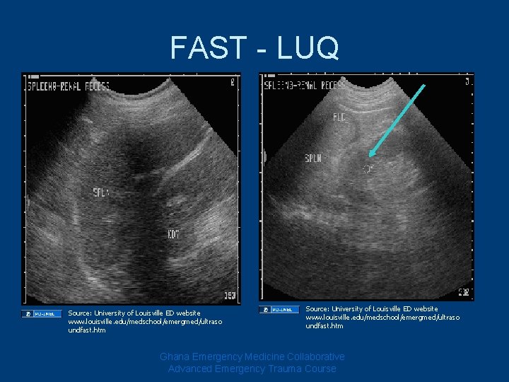 FAST - LUQ Source: University of Louisville ED website www. louisville. edu/medschool/emergmed/ultraso undfast. htm