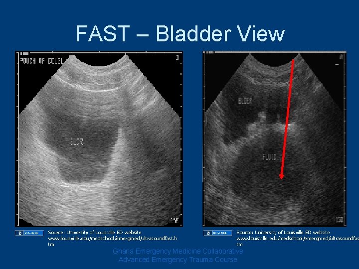 FAST – Bladder View Source: University of Louisville ED website www. louisville. edu/medschool/emergmed/ultrasoundfast. h