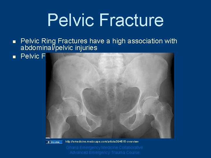 Pelvic Fracture n n Pelvic Ring Fractures have a high association with abdominal/pelvic injuries