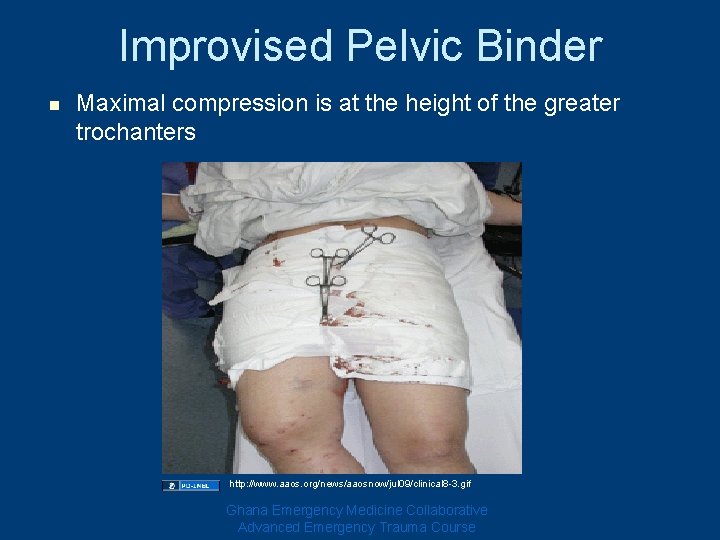 Improvised Pelvic Binder n Maximal compression is at the height of the greater trochanters