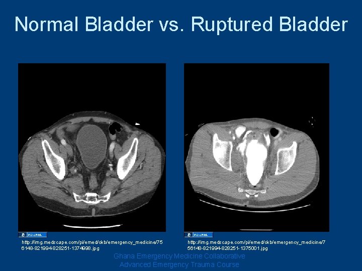 Normal Bladder vs. Ruptured Bladder http: //img. medscape. com/pi/emed/ckb/emergency_medicine/75 6148 -821994 -828251 -1374998. jpg