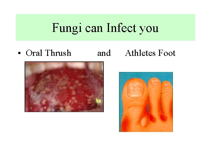 Fungi can Infect you • Oral Thrush and Athletes Foot 