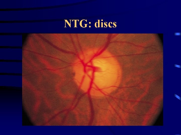 NTG: discs 