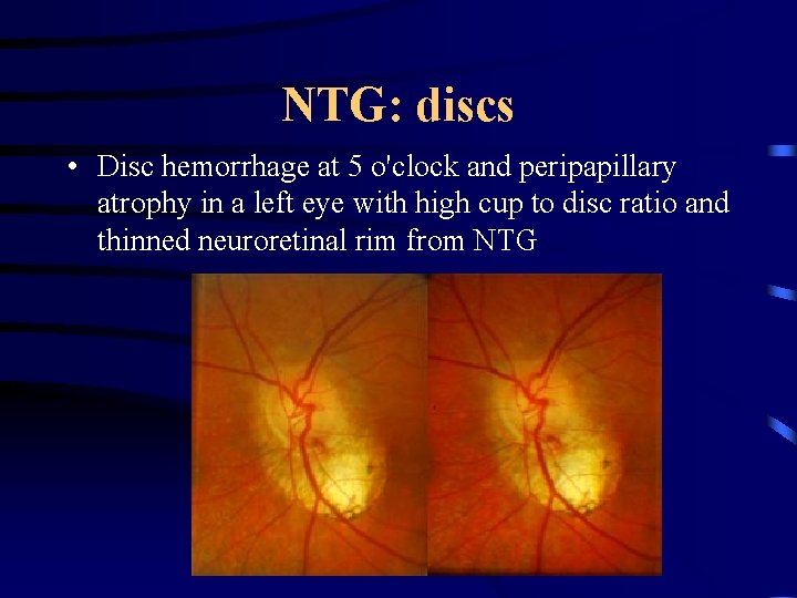 NTG: discs • Disc hemorrhage at 5 o'clock and peripapillary atrophy in a left