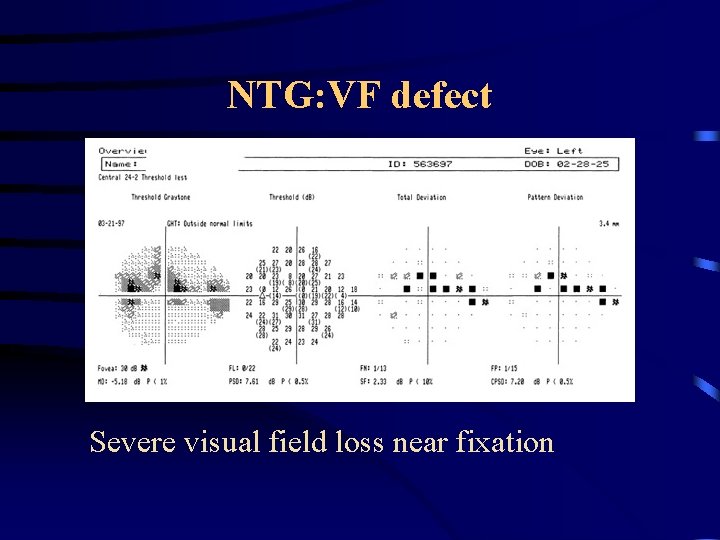 NTG: VF defect Severe visual field loss near fixation 