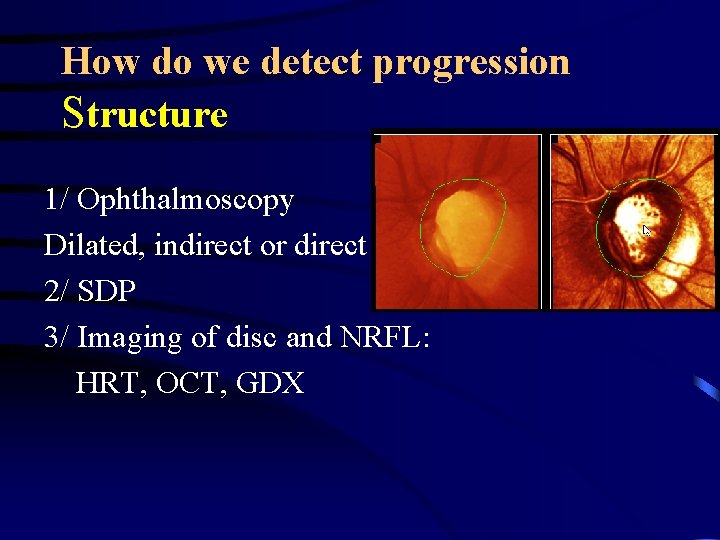 How do we detect progression Structure 1/ Ophthalmoscopy Dilated, indirect or direct 2/ SDP