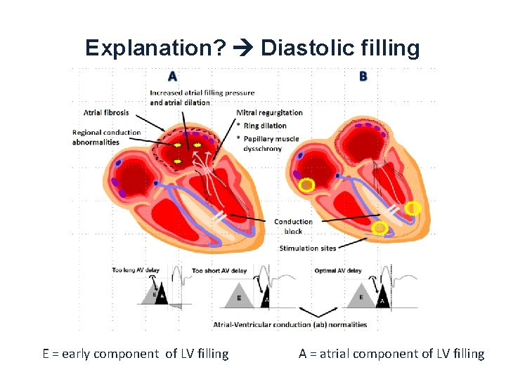 Explanation? Diastolic filling E = early component of LV filling A = atrial component