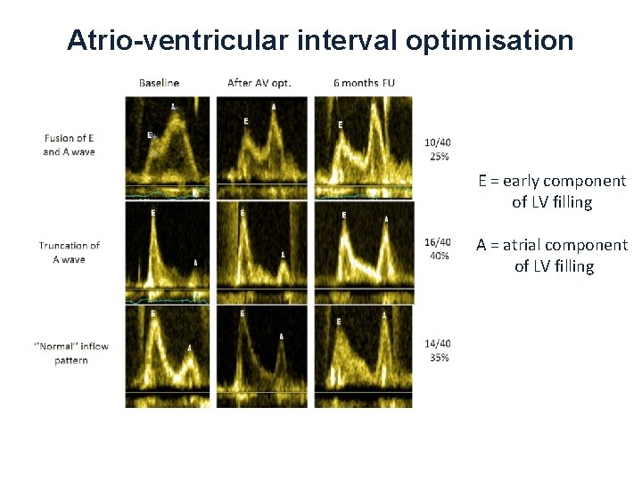 Atrio-ventricular interval optimisation E = early component of LV filling A = atrial component