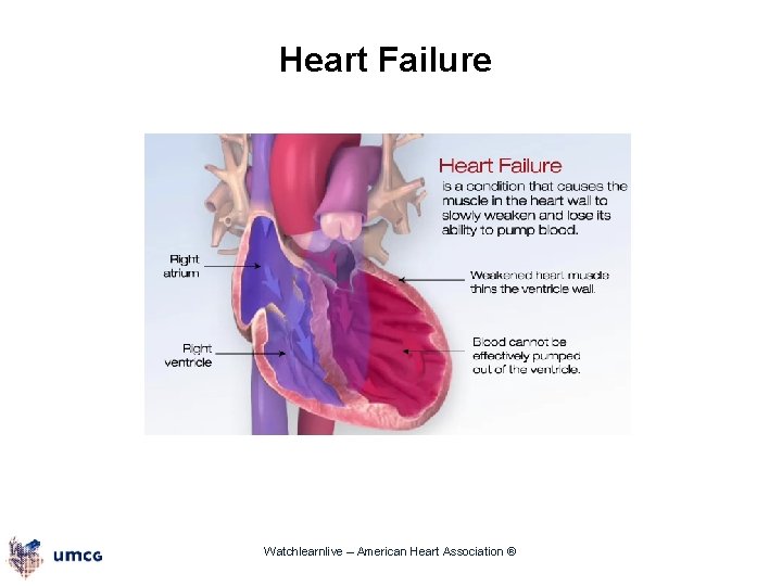 Heart Failure Watchlearnlive – American Heart Association ® 