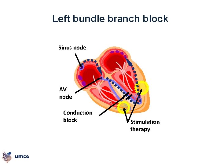 Left bundle branch block Sinus node AV node Conduction block Stimulation therapy 