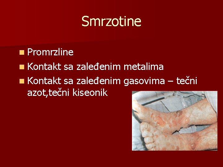 Smrzotine n Promrzline n Kontakt sa zaleđenim metalima n Kontakt sa zaleđenim gasovima –