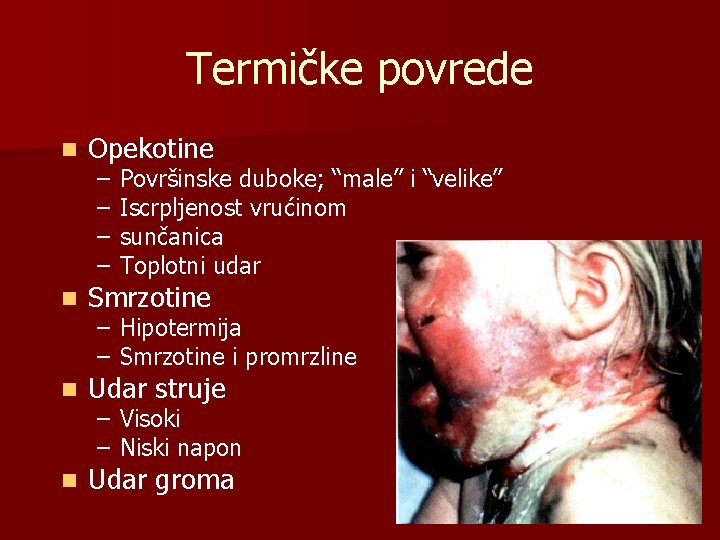 Termičke povrede n Opekotine n Smrzotine n Udar struje n Udar groma – –