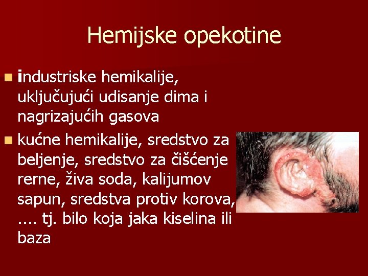 Hemijske opekotine n industriske hemikalije, uključujući udisanje dima i nagrizajućih gasova n kućne hemikalije,