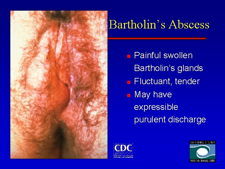 Bartholin’s Abscess n n n Painful swollen Bartholin’s glands Fluctuant, tender May have expressible