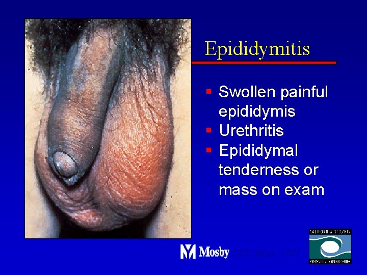 Epididymitis § Swollen painful epididymis § Urethritis § Epididymal tenderness or mass on exam