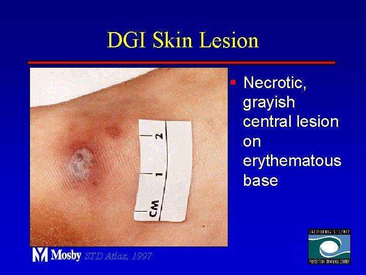 DGI Skin Lesion § Necrotic, grayish central lesion on erythematous base STD Atlas, 1997