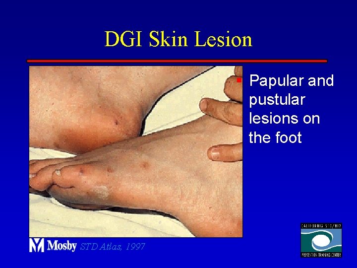 DGI Skin Lesion § Papular and pustular lesions on the foot STD Atlas, 1997