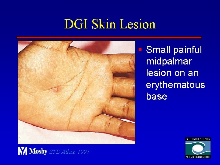 DGI Skin Lesion § Small painful midpalmar lesion on an erythematous base STD Atlas,