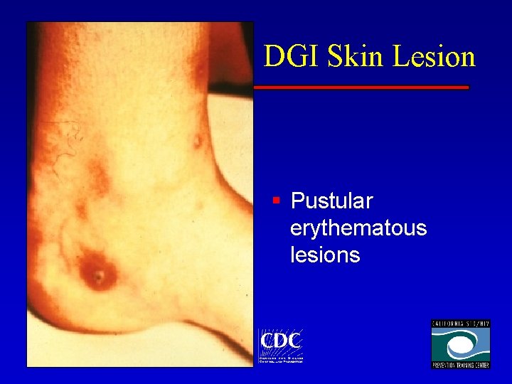 DGI Skin Lesion § Pustular erythematous lesions 