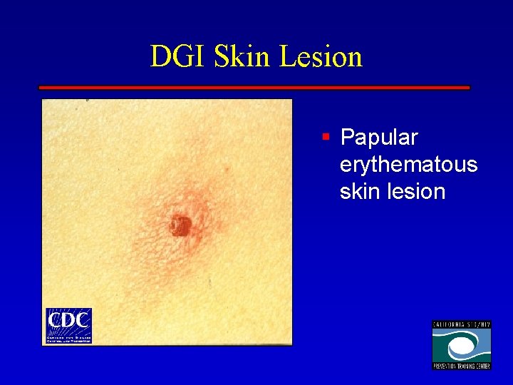 DGI Skin Lesion § Papular erythematous skin lesion 