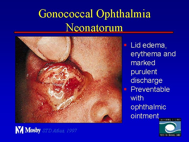 Gonococcal Ophthalmia Neonatorum § Lid edema, erythema and marked purulent discharge § Preventable with