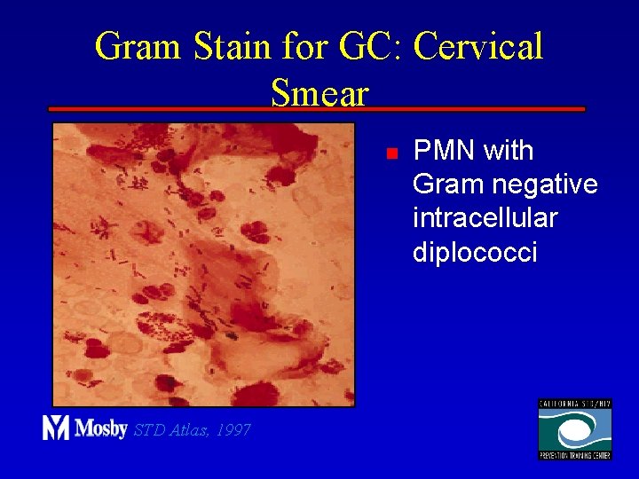 Gram Stain for GC: Cervical Smear n STD Atlas, 1997 PMN with Gram negative