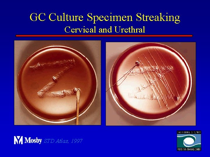 GC Culture Specimen Streaking Cervical and Urethral STD Atlas, 1997 