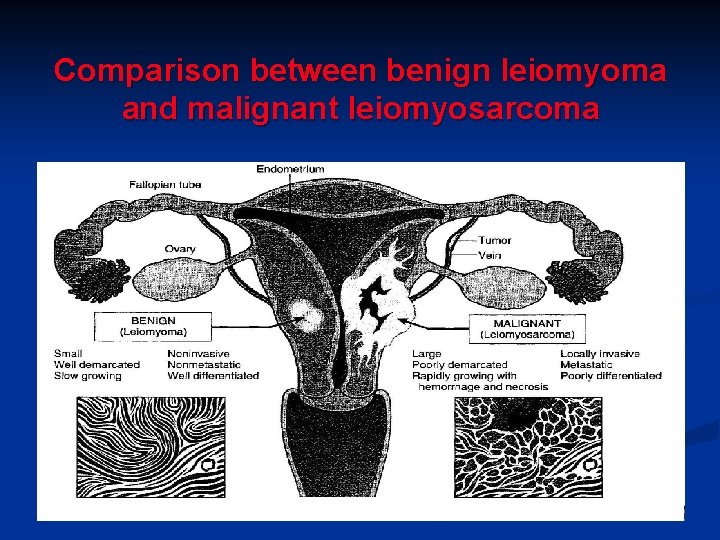 Comparison between benign leiomyoma and malignant leiomyosarcoma 