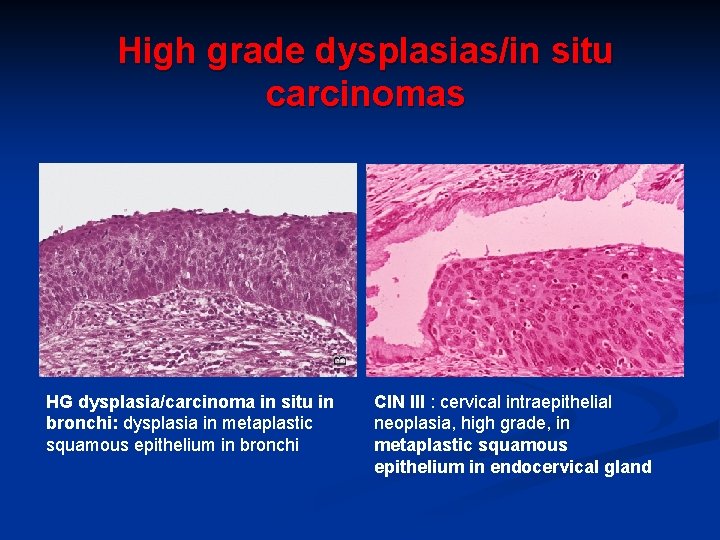 High grade dysplasias/in situ carcinomas HG dysplasia/carcinoma in situ in bronchi: dysplasia in metaplastic