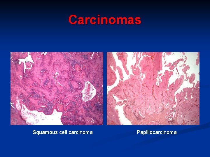 Carcinomas Squamous cell carcinoma Papillocarcinoma 