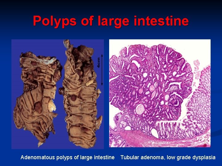 Polyps of large intestine Adenomatous polyps of large intestine Tubular adenoma, low grade dysplasia