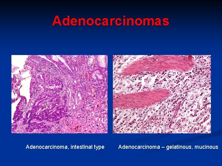 Adenocarcinomas Adenocarcinoma, intestinal type Adenocarcinoma – gelatinous, mucinous 