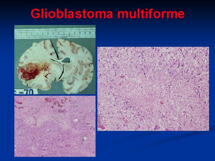 Glioblastoma multiforme 