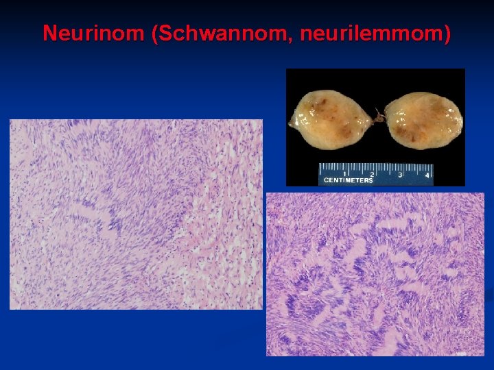 Neurinom (Schwannom, neurilemmom) 