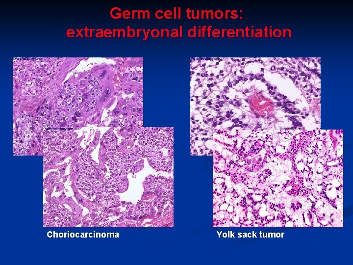 Germ cell tumors: extraembryonal differentiation Choriocarcinoma Yolk sack tumor 