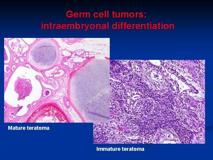 Germ cell tumors: intraembryonal differentiation Mature teratoma Immature teratoma 