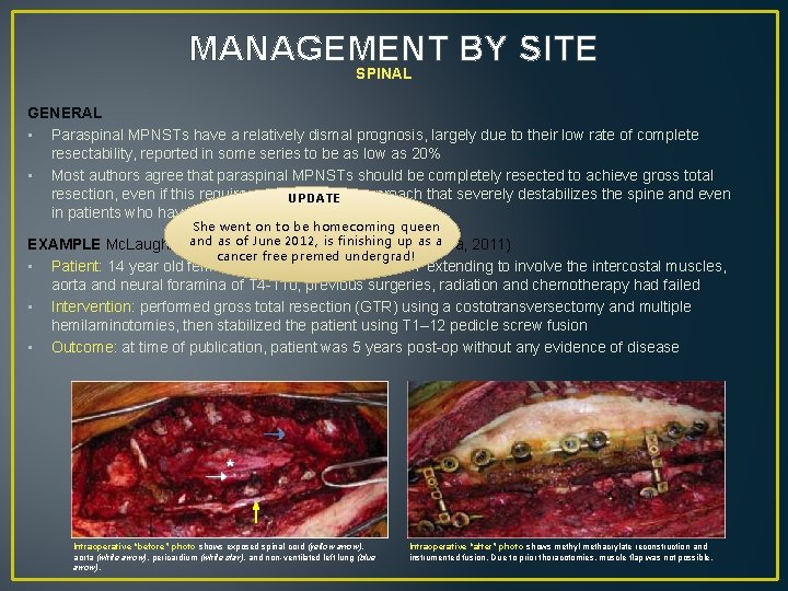MANAGEMENT BY SITE SPINAL GENERAL • Paraspinal MPNSTs have a relatively dismal prognosis, largely