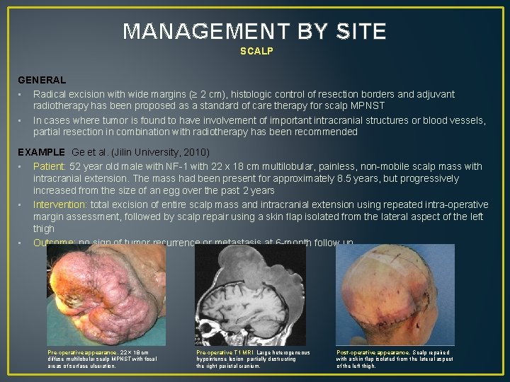 MANAGEMENT BY SITE SCALP GENERAL • Radical excision with wide margins (≥ 2 cm),