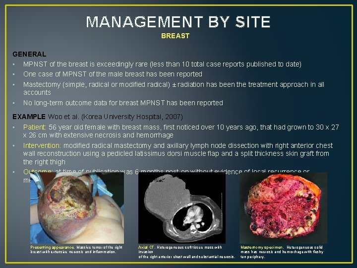 MANAGEMENT BY SITE BREAST GENERAL • MPNST of the breast is exceedingly rare (less