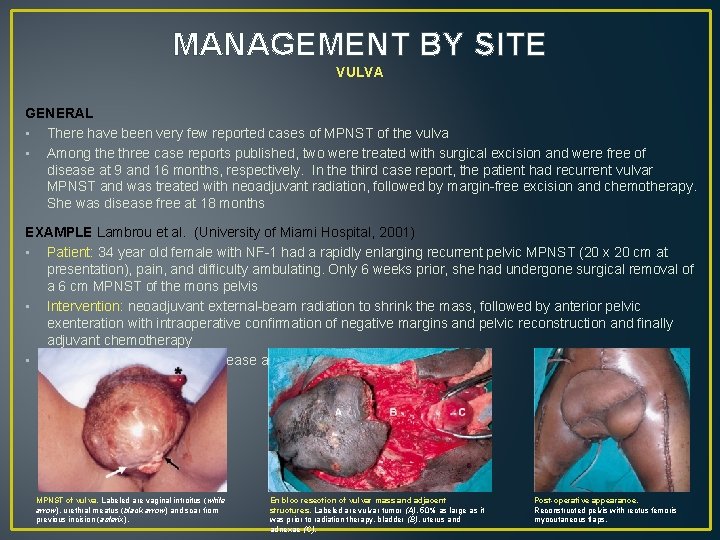 MANAGEMENT BY SITE VULVA GENERAL • There have been very few reported cases of